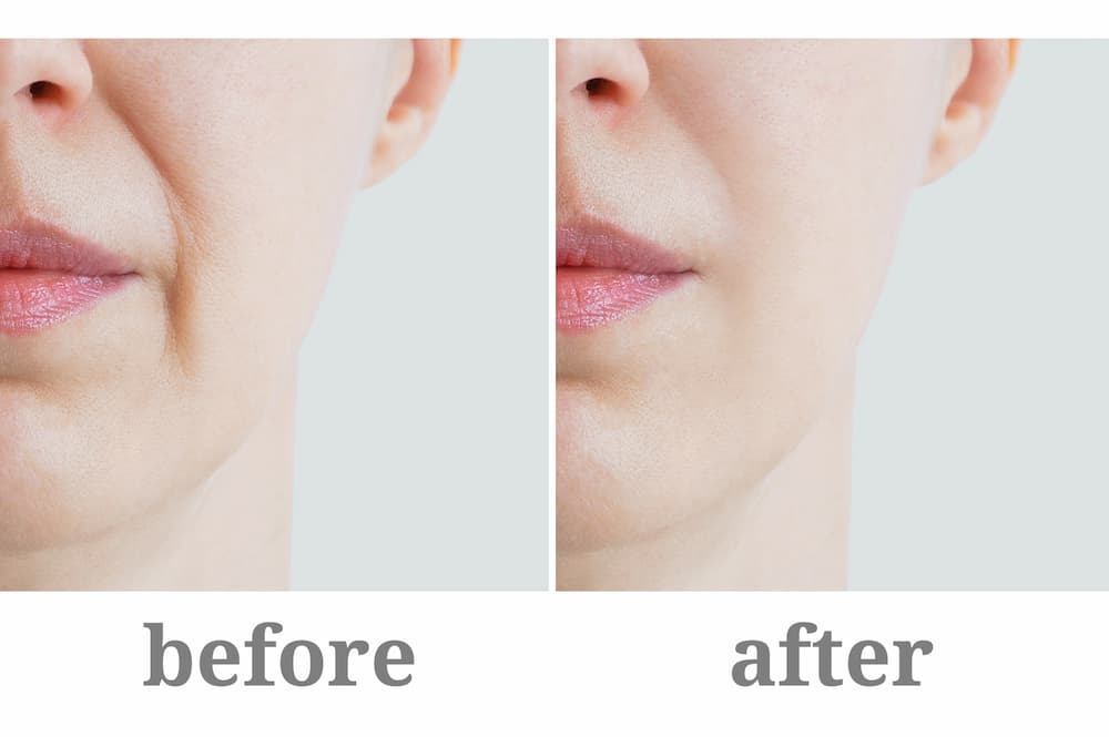 Before and after image of a patient of EHormones MD while receiving Anti-Aging Fillers